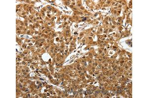 Immunohistochemistry of Human lung cancer using SOX13 Polyclonal Antibody at dilution of 1:50 (SOX13 antibody)