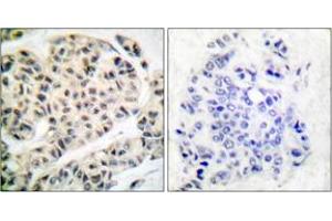 Immunohistochemistry analysis of paraffin-embedded human breast carcinoma, using MEF2A (Phospho-Thr319) Antibody. (MEF2A antibody  (pThr319))