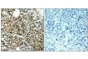 Immunohistochemical analysis of paraffin-embedded human breast carcinoma tissue using G3BP-1 (Ab-232) antibody (E021102). (G3BP1 antibody)