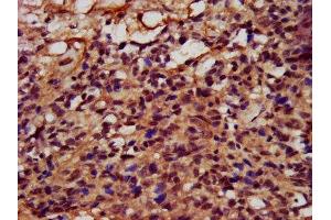 IHC image of ABIN7152727 diluted at 1:400 and staining in paraffin-embedded human ovarian cancer performed on a Leica BondTM system. (FATE1 antibody  (AA 1-162))