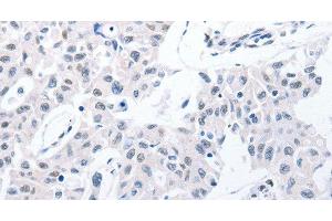 Immunohistochemistry of paraffin-embedded Human lung cancer using POMC Polyclonal Antibody at dilution of 1:30 (POMC antibody)