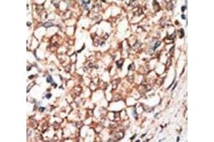 IHC analysis of FFPE human hepatocarcinoma tissue stained with the BMPR1B antibody