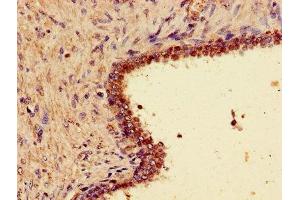 Immunohistochemistry of paraffin-embedded human prostate cancer using ABIN7166309 at dilution of 1:100