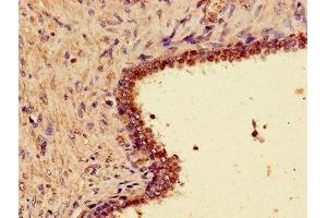 Immunohistochemistry of paraffin-embedded human prostate cancer using ABIN7166309 at dilution of 1:100 (WNT7A antibody  (AA 126-302))