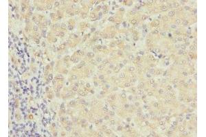Immunohistochemistry of paraffin-embedded human liver cancer using ABIN7167233 at dilution of 1:100 (RAB17 antibody  (AA 1-212))