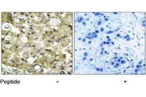 Immunohistochemical analysis of paraffin-embedded human breast carcinoma tissue using KDR polyclonal antibody  . (VEGFR2/CD309 antibody)