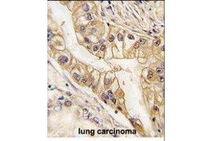 Paraformaldehyde-fixed, paraffin embedded human lung carcinoma tissue, Antigen retrieval by boiling in sodium citrate buffer (pH6. (EPH Receptor B2 antibody)