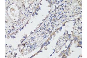 Immunohistochemistry of paraffin-embedded human lung cancer using NTRK2 antibody (ABIN5998390) at dilution of 1/200 (40x lens). (TRKB antibody)