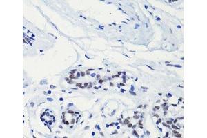 Immunohistochemistry of paraffin-embedded Human breast using Acetyl-Histone H2A-K5 Polyclonal Antibody at dilution of 1:100 (40x lens).