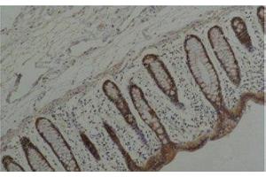 Immunohistochemistry of paraffin-embedded Human colon carcinoma tissue using HSP90 alpha Monoclonal Antibody at dilution of 1:200. (HSP90AA2 antibody)
