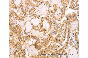 Immunohistochemistry of Human thyroid cancer using NAMPT Polyclonal Antibody at dilution of 1:30