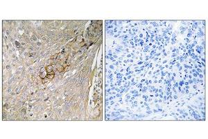 Immunohistochemistry analysis of paraffin-embedded human lung carcinoma tissue, using SC6A6 antibody. (TAUT antibody  (C-Term))