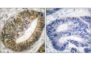 Immunohistochemistry analysis of paraffin-embedded human colon carcinoma, using SEPARASE (Phospho-Ser801) Antibody. (Separase antibody  (pSer801))