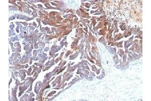 Formalin-fixed, paraffin-embedded human ovarian carcinoma stained with TAG-72 antibody (B72.