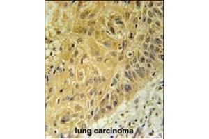 WNT5A Antibody (Center) (ABIN651869 and ABIN2840430) immunohistochemistry analysis in formalin fixed and paraffin embedded human lung carcinoma followed by peroxidase conjugation of the secondary antibody and DAB staining. (WNT5A antibody  (AA 185-213))