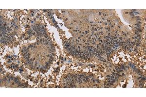 Immunohistochemistry of paraffin-embedded Human colon cancer tissue using JAG2 Polyclonal Antibody at dilution 1:30 (JAG2 antibody)