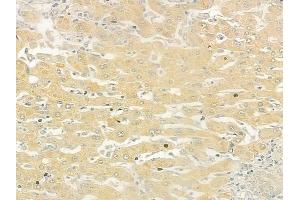 ABIN6260830 and ABIN6279242 at 1/100 staining human hepatocellular carcinoma by IHC-P.