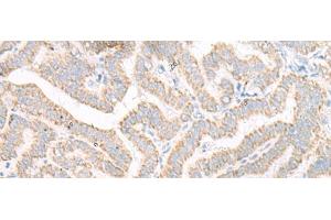 Immunohistochemistry of paraffin-embedded Human thyroid cancer tissue using ACSF2 Polyclonal Antibody at dilution of 1:30(x200) (ACSF2 antibody)