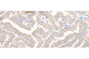 Immunohistochemistry of paraffin-embedded Human thyroid cancer tissue using ACSF2 Polyclonal Antibody at dilution of 1:30(x200)