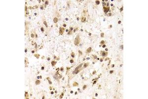 Immunohistochemistry of paraffin-embedded human liver cancer using PRPF3 Antibody.