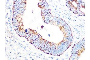 Immunohistochemistry of paraffin-embedded human colon carcinoma using PDHB Rabbit mAb (ABIN7269772) at dilution of 1:100 (40x lens). (PDHB antibody)