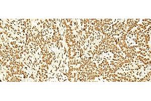 Immunohistochemistry of paraffin-embedded Human ovarian cancer tissue using ILF3 Polyclonal Antibody at dilution of 1:60(x200) (Interleukin enhancer-binding factor 3 (ILF3) antibody)