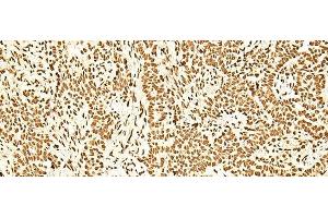 Immunohistochemistry of paraffin-embedded Human ovarian cancer tissue using ILF3 Polyclonal Antibody at dilution of 1:60(x200)