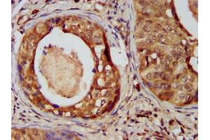 IHC image of ABIN7148726 diluted at 1:400 and staining in paraffin-embedded human cervical cancer performed on a Leica BondTM system. (CSMD3 antibody  (AA 233-380))