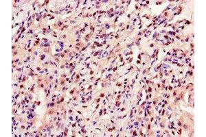 Immunohistochemistry of paraffin-embedded human lung cancer using ABIN7144222 at dilution of 1:100 (ANKRD23 antibody  (AA 1-200))