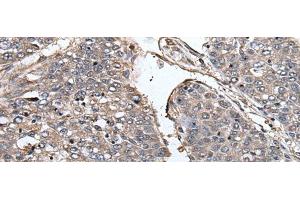 Immunohistochemistry of paraffin-embedded Human liver cancer tissue using PRUNE Polyclonal Antibody at dilution of 1:40(x200) (PRUNE antibody)
