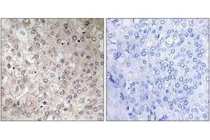 Immunohistochemistry analysis of paraffin-embedded human liver carcinoma tissue, using GIPR Antibody. (GIPR antibody  (AA 93-142))