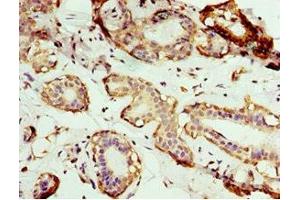 Immunohistochemistry of paraffin-embedded human breast cancer using ABIN7144352 at dilution of 1:100 (AP1m2 antibody  (AA 164-423))