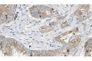 ABIN6278588 at 1/100 staining Human prostate tissue by IHC-P. (GAL4 antibody  (N-Term))