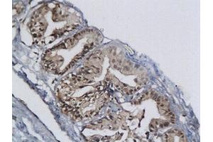 Formalin-fixed and paraffin embedded bladder cancer labeled with Anti-MCM-2 Polyclonal Antibody, Unconjugated  at 1:200 followed by conjugation to the secondary antibody and DAB staining (MCM2 antibody  (AA 601-700))