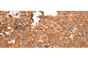 Immunohistochemistry of paraffin-embedded Human ovarian cancer tissue using HOXD8 Polyclonal Antibody at dilution of 1:40(x200) (HOXD8 antibody)
