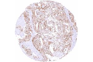 Clear cell ovarian carcinoma with moderate occludin staining of tumor cells (Occludin antibody  (AA 282-415))