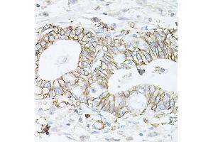 Immunohistochemistry of paraffin-embedded human gastric cancer using B1 antibody (ABIN6127389, ABIN6137306, ABIN6137309 and ABIN6221475) at dilution of 1:100 (40x lens).