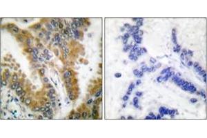 Immunohistochemistry analysis of paraffin-embedded human lung carcinoma tissue, using CrkL (Ab-207) Antibody. (CrkL antibody  (AA 173-222))