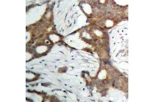 Immunohistochemical analysis of Androgen Receptor staining in human prostate cancer formalin fixed paraffin embedded tissue section. (Androgen Receptor antibody)