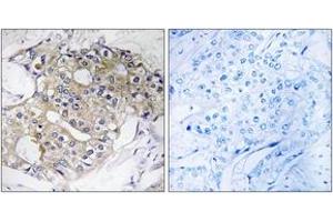 Immunohistochemistry analysis of paraffin-embedded human breast carcinoma tissue, using DHRS4 Antibody.