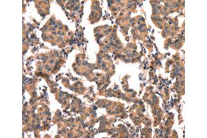 Immunohistochemistry of Human liver cancer using CGA Polyclonal Antibody at dilution of 1:65 (hCG antibody)
