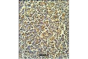 CORO6 Antibody (C-term) (ABIN651024 and ABIN2840040) IHC analysis in formalin fixed and paraffin embedded lymph carcinoma followed by peroxidase conjugation of the secondary antibody and DAB staining. (Coronin 6 antibody  (C-Term))