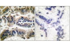 Immunohistochemistry analysis of paraffin-embedded human breast carcinoma tissue, using Caspase 6 (Ab-257) Antibody. (Caspase 6 antibody  (AA 223-272))
