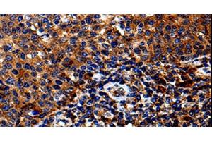 Immunohistochemistry of paraffin-embedded Human tosil tissue using IL13RA1 Polyclonal Antibody at dilution 1:50 (IL13 Receptor alpha 1 antibody)