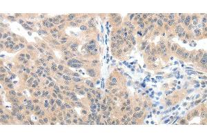 Immunohistochemistry of paraffin-embedded Human ovarian cancer tissue using SLC20A1 Polyclonal Antibody at dilution 1:40 (SLC20A1 antibody)