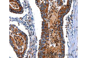 Immunohistochemistry of Human esophagus cancer using ITGA7 Polyclonal Antibody at dilution of 1:35 (ITGA7 antibody)