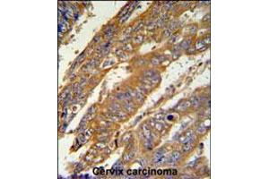 PAN3 Antibody IHC analysis in formalin fixed and paraffin embedded human cervix carcinoma followed by peroxidase conjugation of the secondary antibody and DAB staining. (PAN3 antibody  (C-Term))