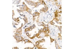 Immunohistochemistry of paraffin-embedded Human lung adenocarcinoma (egfr-l858r positive sample) 2 using EGFR (L858R) Rabbit mAb (ABIN7266981) at dilution of 1:100 (40x lens). (EGFR antibody)