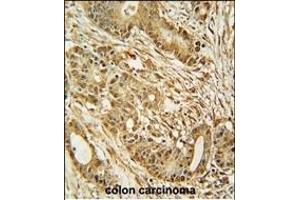 MCM2 Antibody (C-term) (ABIN653324 and ABIN2842815) immunohistochemistry analysis in formalin fixed and paraffin embedded human colon carcinoma followed by peroxidase conjugation of the secondary antibody and DAB staining. (MCM2 antibody  (C-Term))
