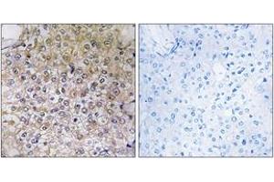 Immunohistochemistry analysis of paraffin-embedded human breast carcinoma tissue, using ATP6V1B1 Antibody. (ATP6V1B1 antibody  (AA 381-430))